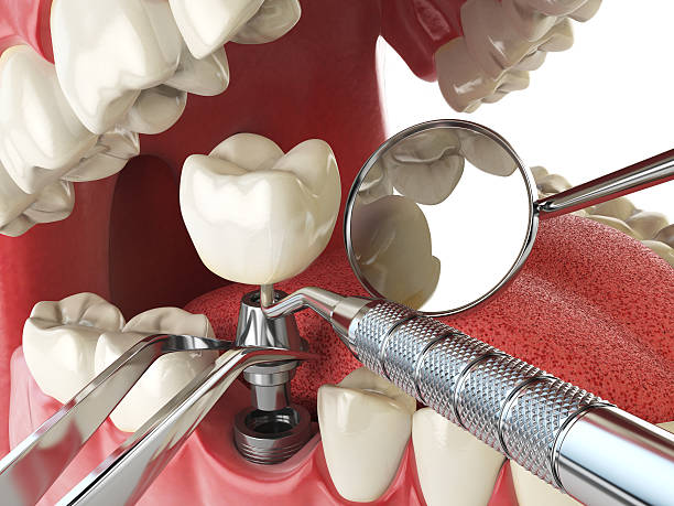 Best Chipped Tooth Repair Near Me  in Scappoose, OR